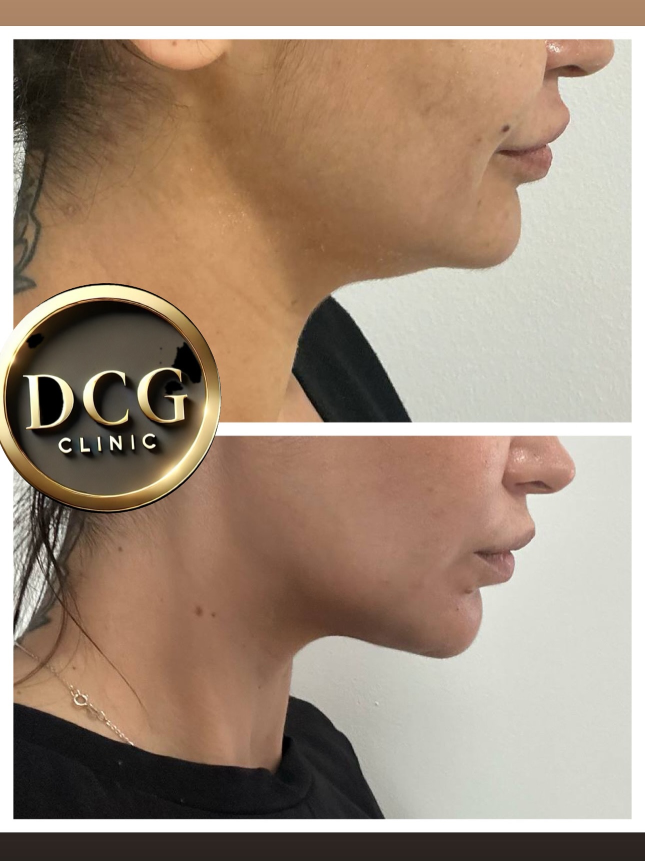 Endolift before and after — Double chin