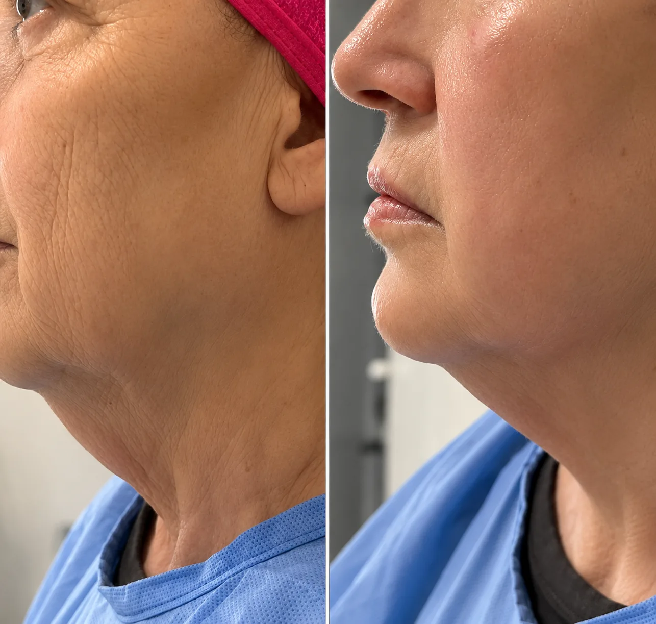 Endolift before and after — Neck & jawline rejuvenation